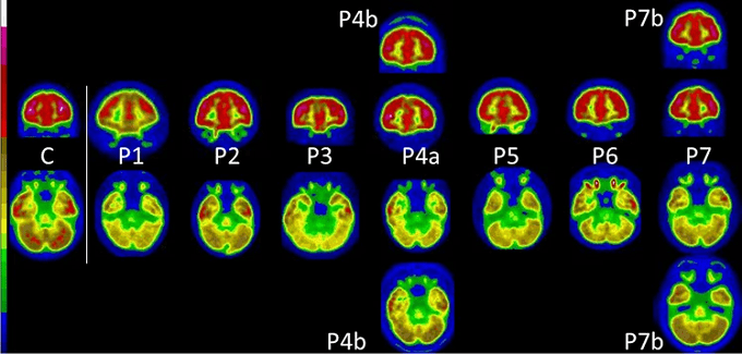 PET scans of long covid affected children show similar damage to those of adults with long covid