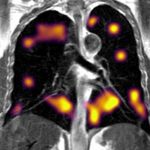 Long Covid: Lung abnormalities found in patients with breathlessness
