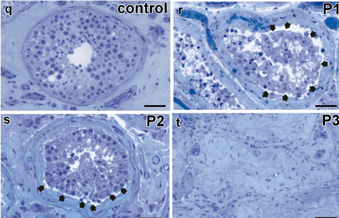 Preprint: SARS-CoV-2 infects and replicates in human testes