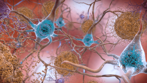 Beta-Amyloid Plaques and Tau in the Brain