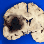 Preprint: Autopsies reveal Covid-19 brain damage
