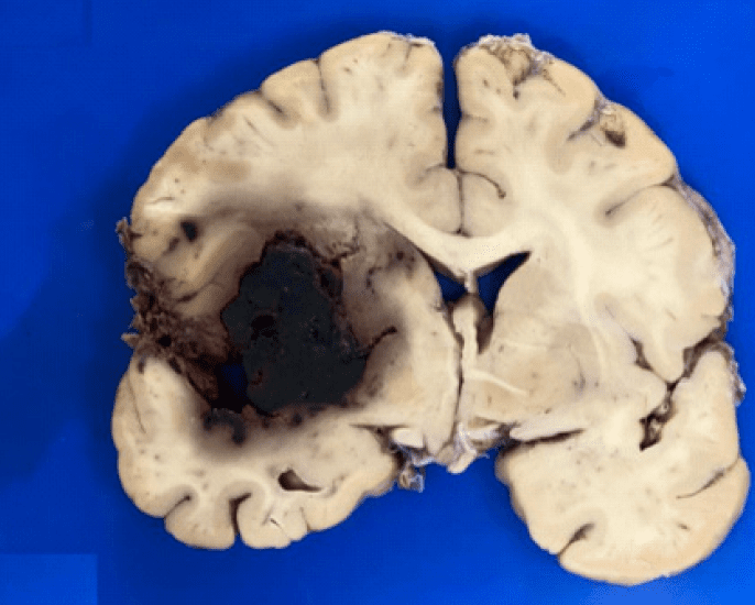 Preprint: Autopsies reveal Covid-19 brain damage
