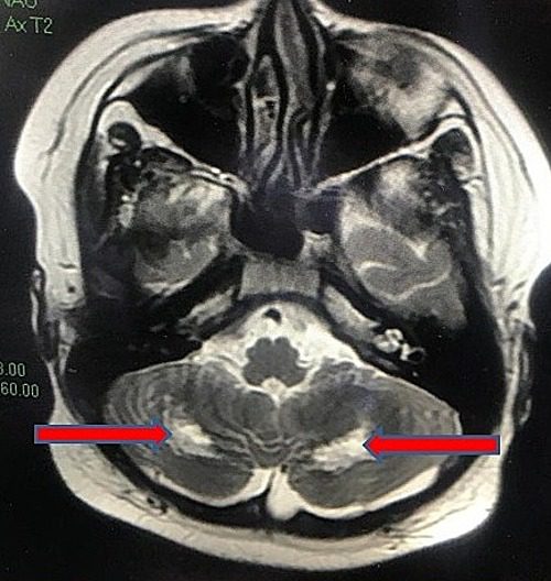 Brain and liver damage in 13yr old in Vietnam