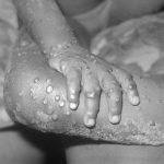 Monkeypox pandemic predicted in March 2021 to kill 270 million *1 Update*