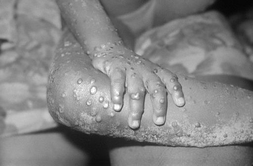 Monkeypox pandemic predicted in March 2021 to kill 270 million *1 Update*