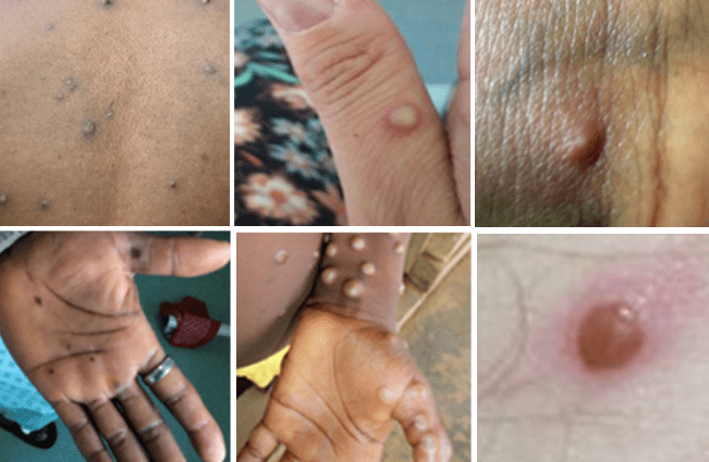 UK: More than 1,000 cases of Monkeypox in Britain
