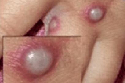 Monkeypox-lesions