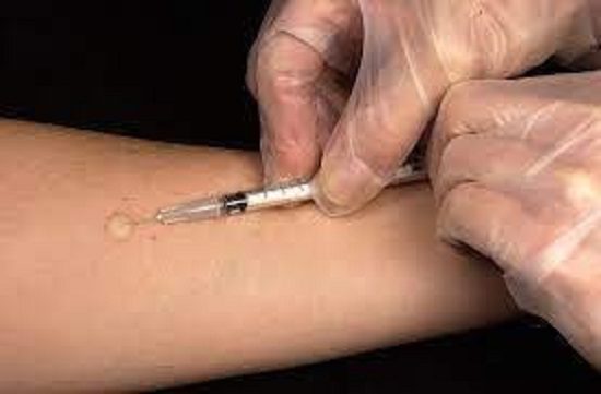Mpox intradermal injection